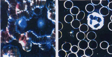 Before QRS treatment: (left) A Rouleau partly with occlusions of erythrocytes (red blood cells). After QRS treatment: (right) The erythrocytes are visible one by one and can be well differentiated from on another.