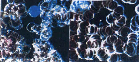 Before QRS treatment: (left) Thrombosis of erythrocytes with possible prickles and a pronounced oxygen deficiency. After QRS treatment: (right) Regress of the thrombosis, forming of Roulleaus, regress of the oxygen deficiency.