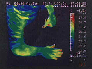 The thermograph clearly shows an improved blood circulationand a higher temperature by 2,6  C.